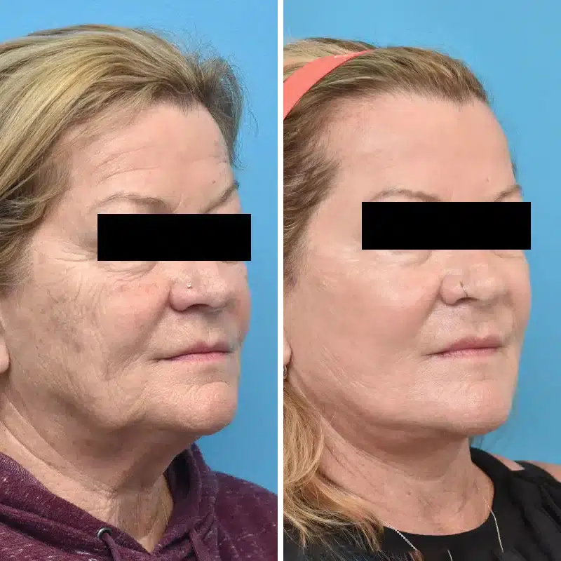 Before & After Photos Kirk Lozada, MD