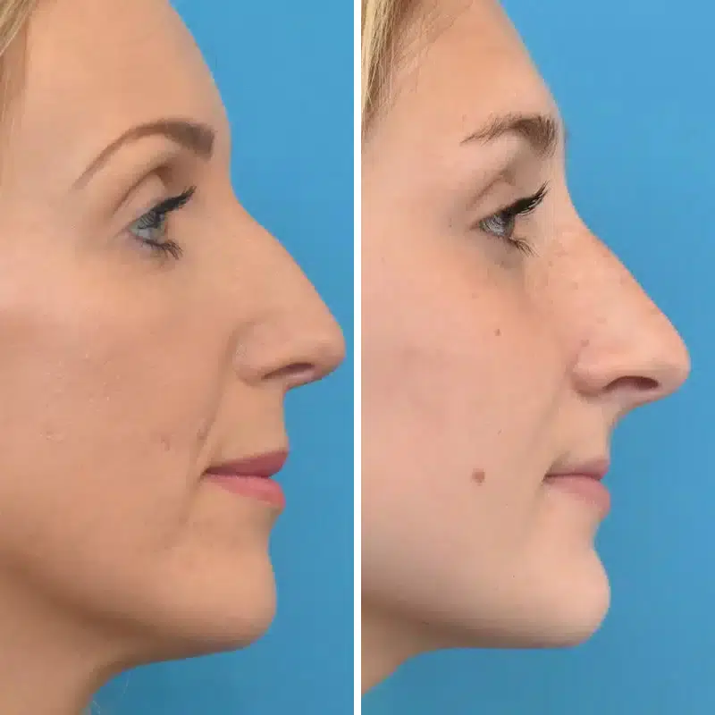 Before & After Photos Kirk Lozada, MD