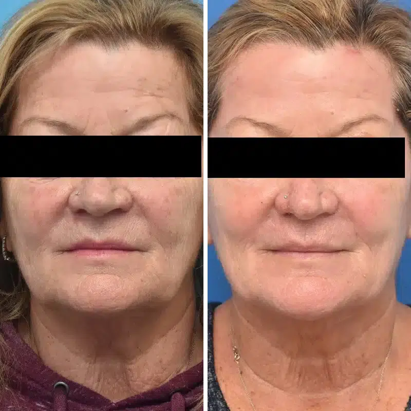 Before & After Photos Kirk Lozada, MD