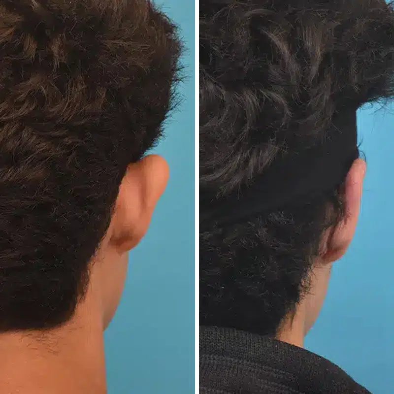 Before & After Photos Kirk Lozada, MD