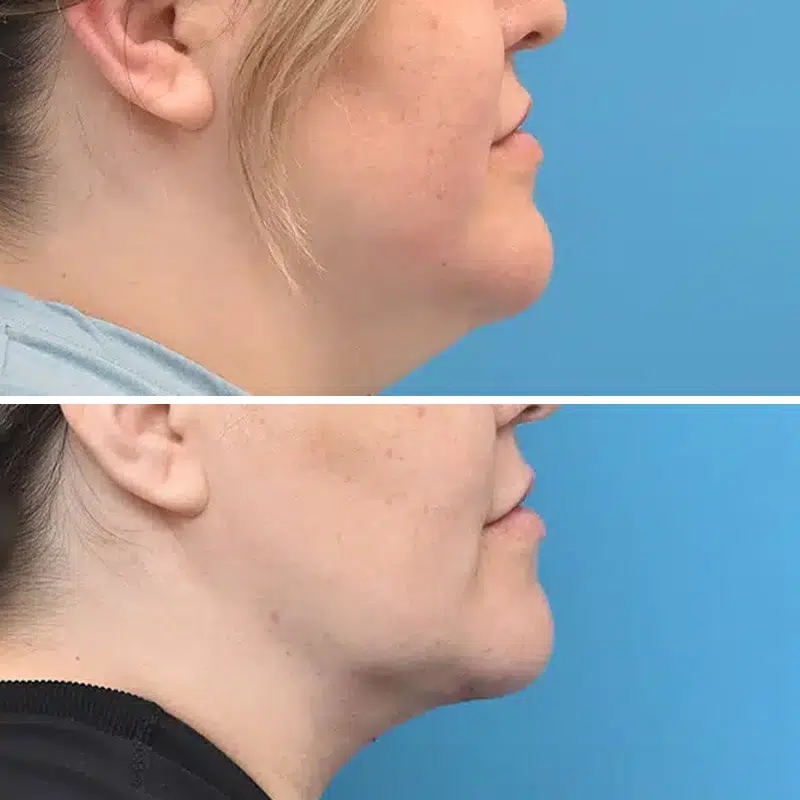 Before & After Photos Kirk Lozada, MD