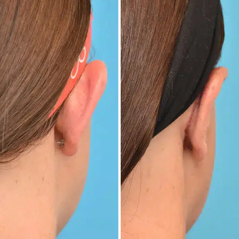 Before & After Photos Kirk Lozada, MD