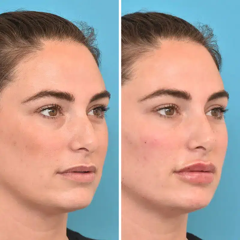 Before & After Photos Kirk Lozada, MD