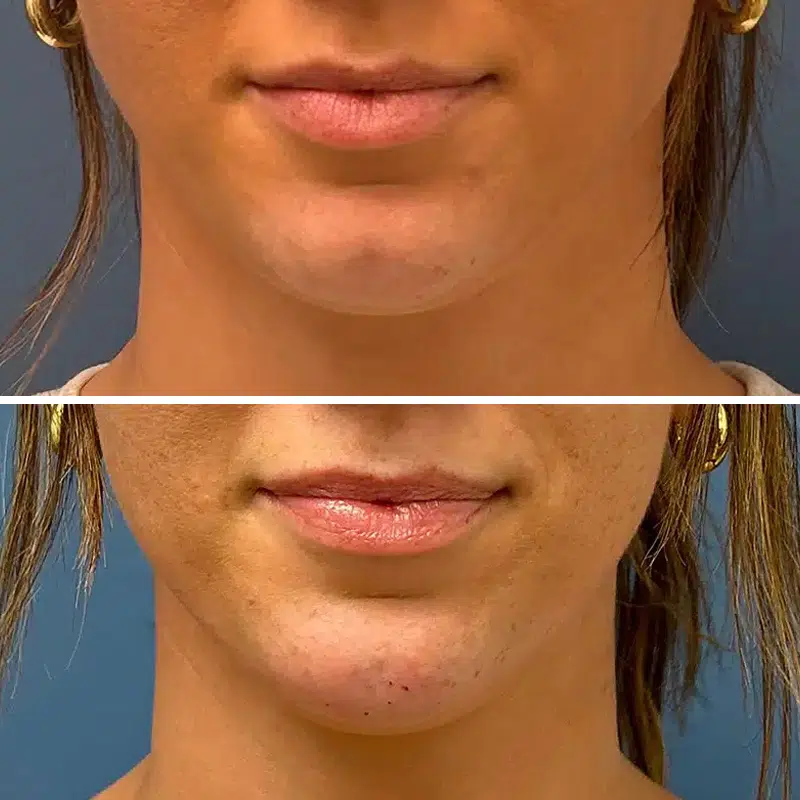 Before & After Photos Joanna Kam, MD