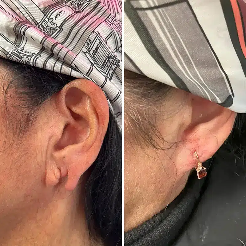 Before & After Photos Joanna Kam, MD