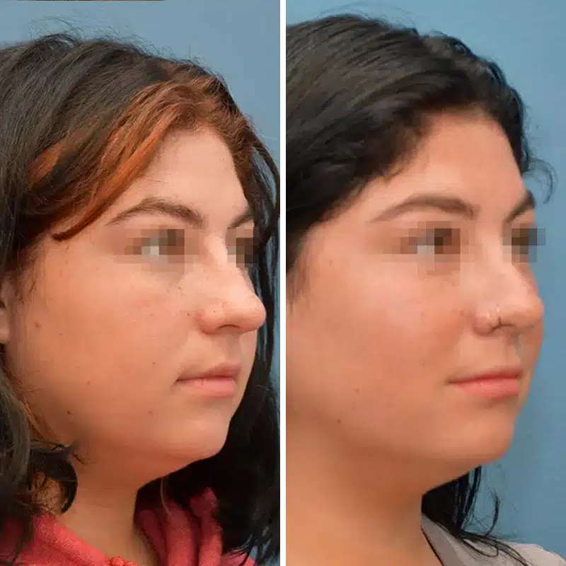 Before & After Photos Joanna Kam, MD