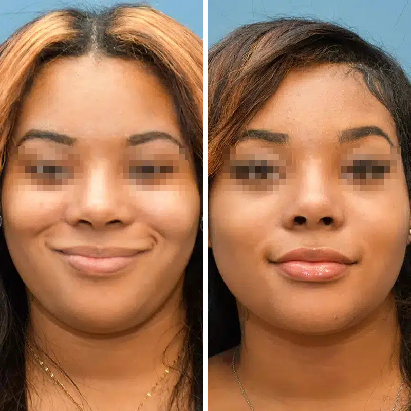 Before & After Photos Joanna Kam, MD