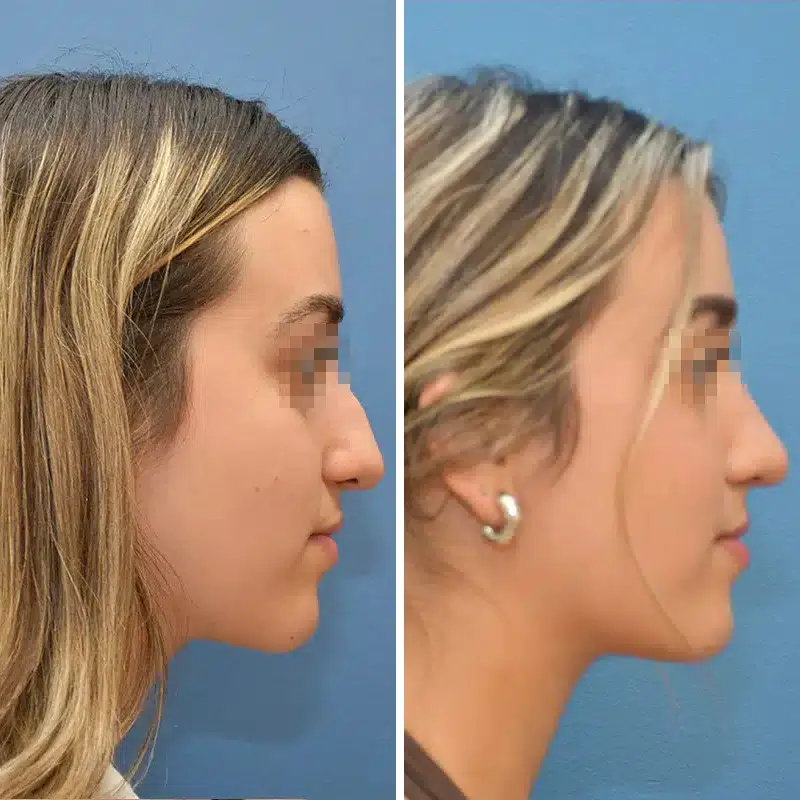 Before & After Photos Joanna Kam, MD