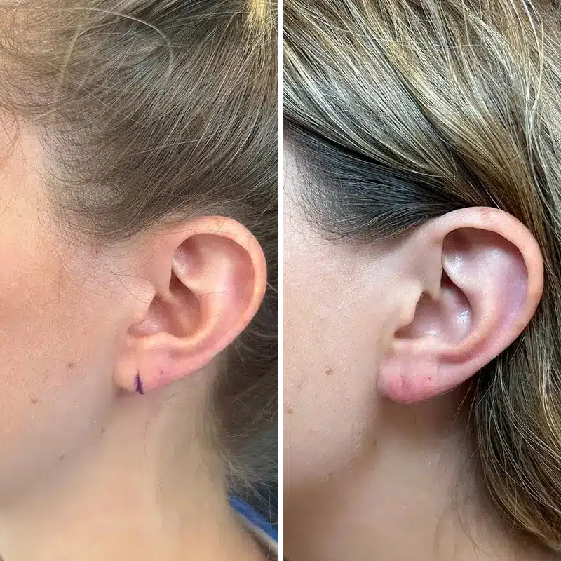 Before & After Photos Alisa Yamasaki, MD