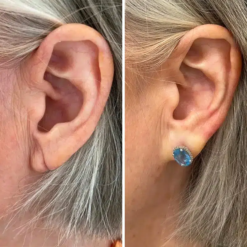 Before & After Photos Alisa Yamasaki, MD