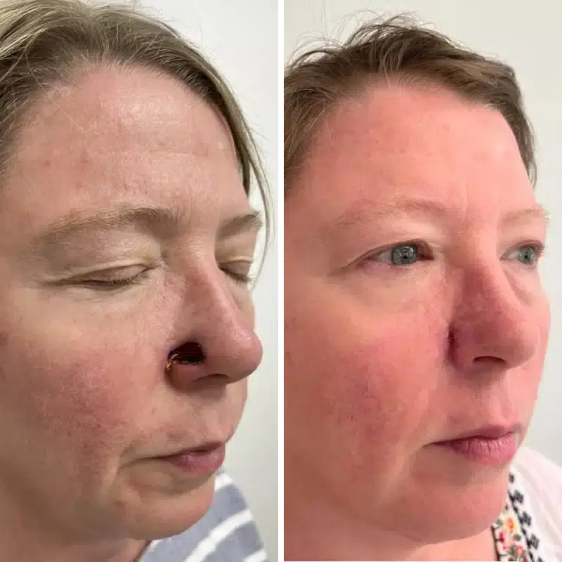 Before & After Photos Alisa Yamasaki, MD