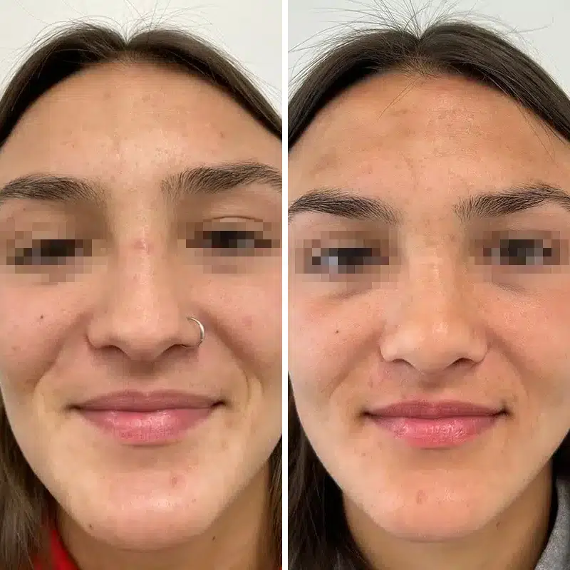 Before & After Photos Alisa Yamasaki, MD