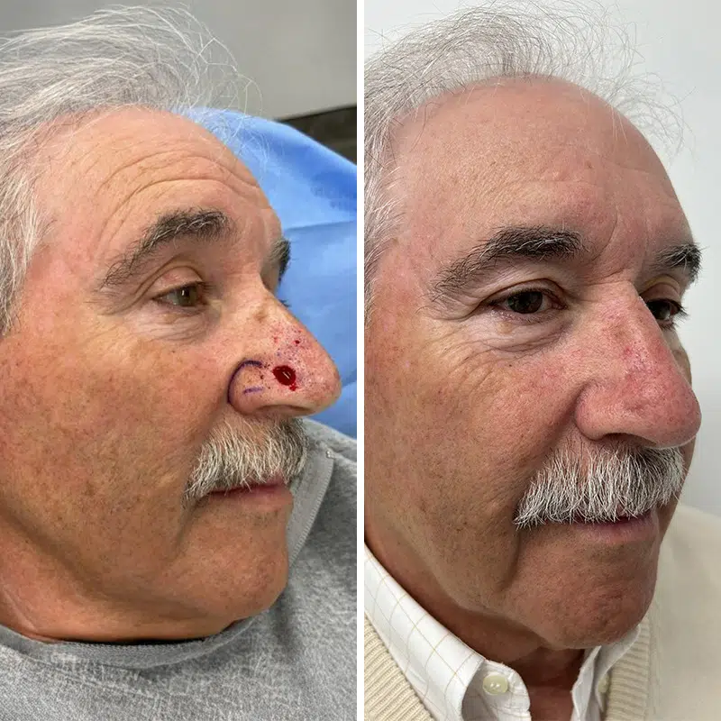 Before & After Photos Alisa Yamasaki, MD