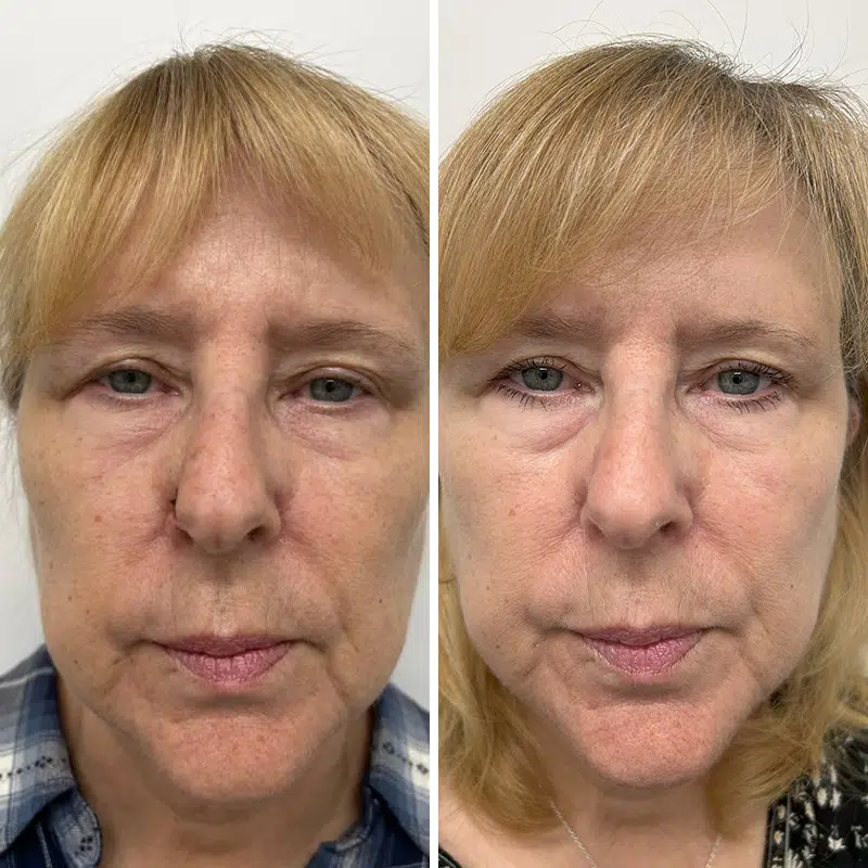 Before & After Photos Alisa Yamasaki, MD