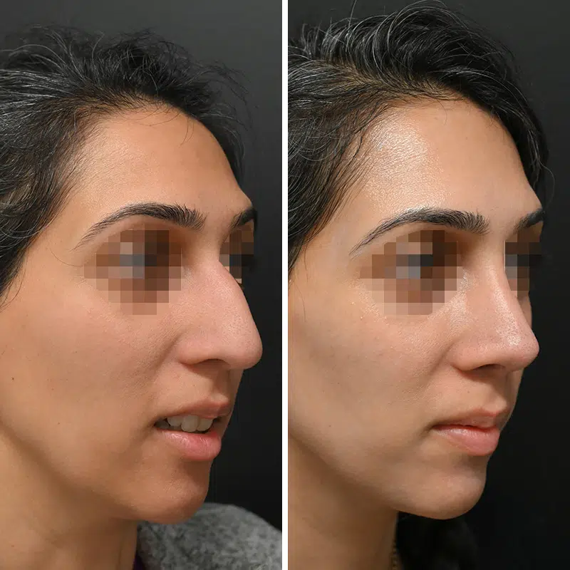 Before & After Photos Alisa Yamasaki, MD
