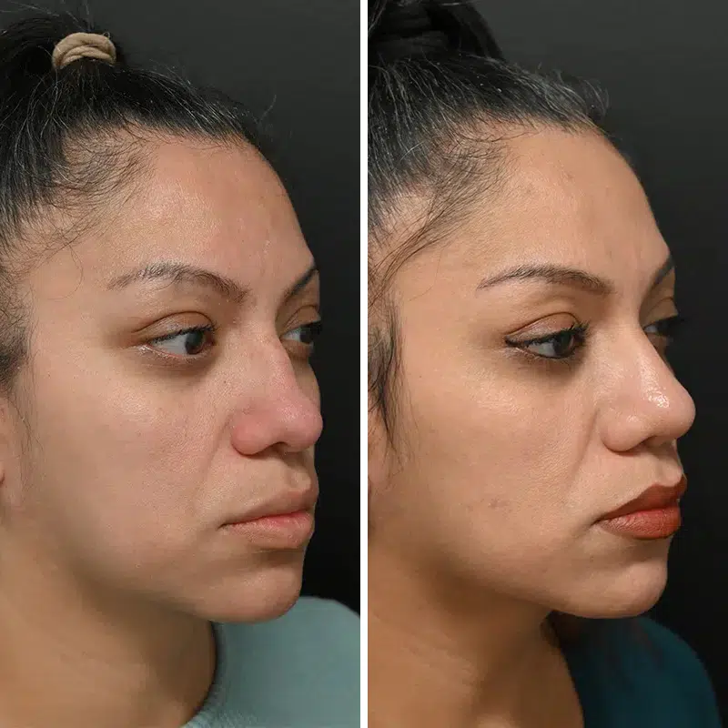 Before & After Photos Alisa Yamasaki, MD