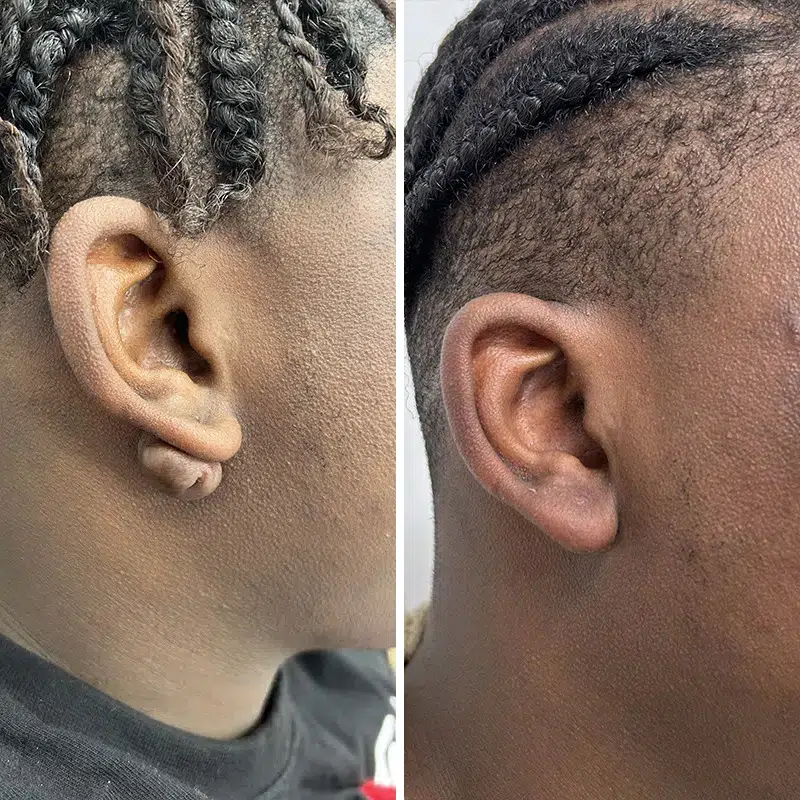 Before & After Photos Alisa Yamasaki, MD