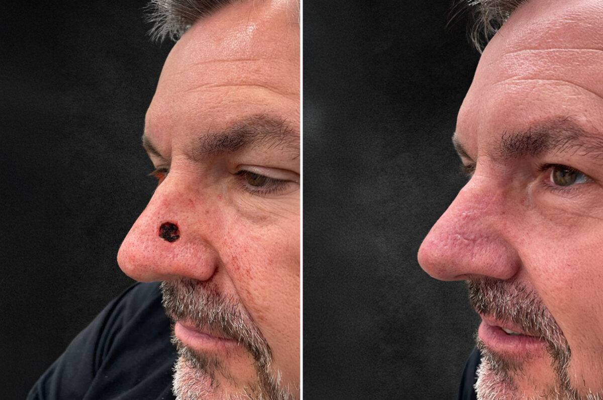 Reconstructive Surgery Before and After Photos in Philadelphia, PA, Patient 10719