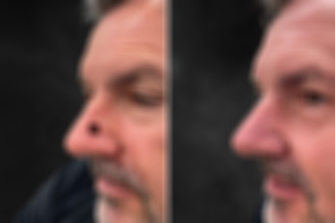 Reconstructive Surgery Before and After Photos in Philadelphia, PA, Patient 10719