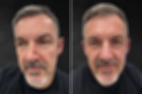 Reconstructive Surgery Before and After Photos in Philadelphia, PA, Patient 10719