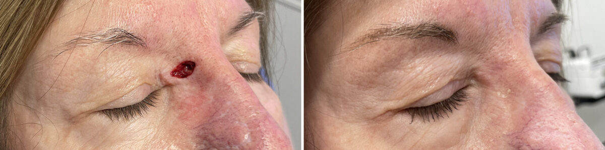 Reconstructive Surgery Before and After Photos in Philadelphia, PA, Patient 10762