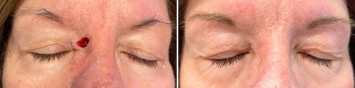 Reconstructive Surgery Before and After Photos in Philadelphia, PA, Patient 10762