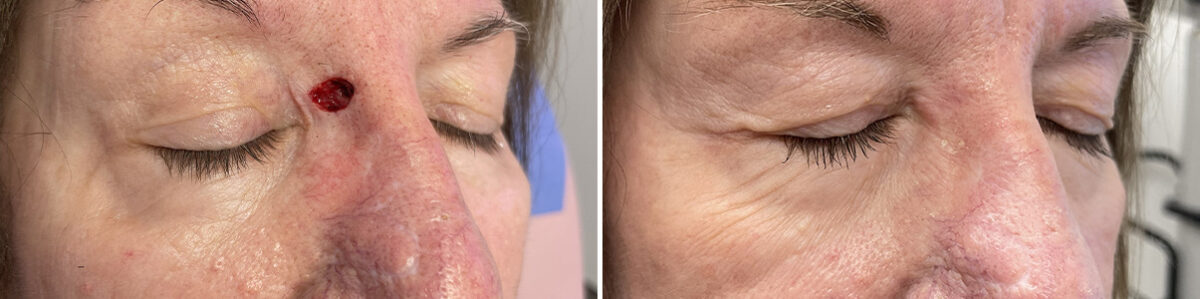 Reconstructive Surgery Before and After Photos in Philadelphia, PA, Patient 10762