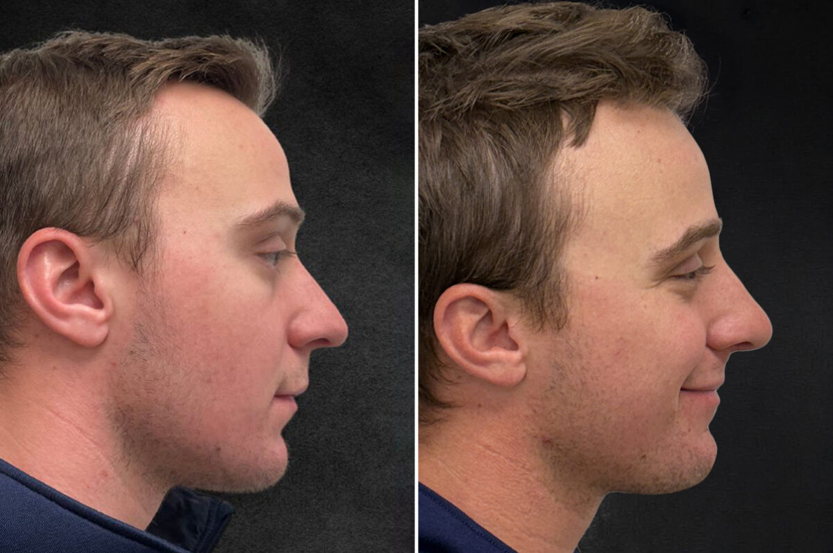 Rhinoplasty Before and After Photos in Philadelphia, PA, Patient 10850