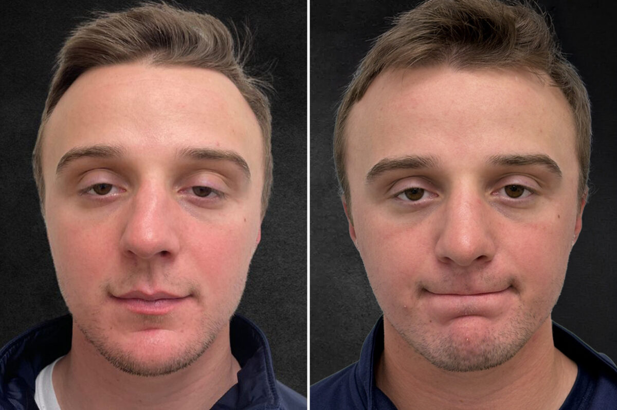 Rhinoplasty Before and After Photos in Philadelphia, PA, Patient 10850
