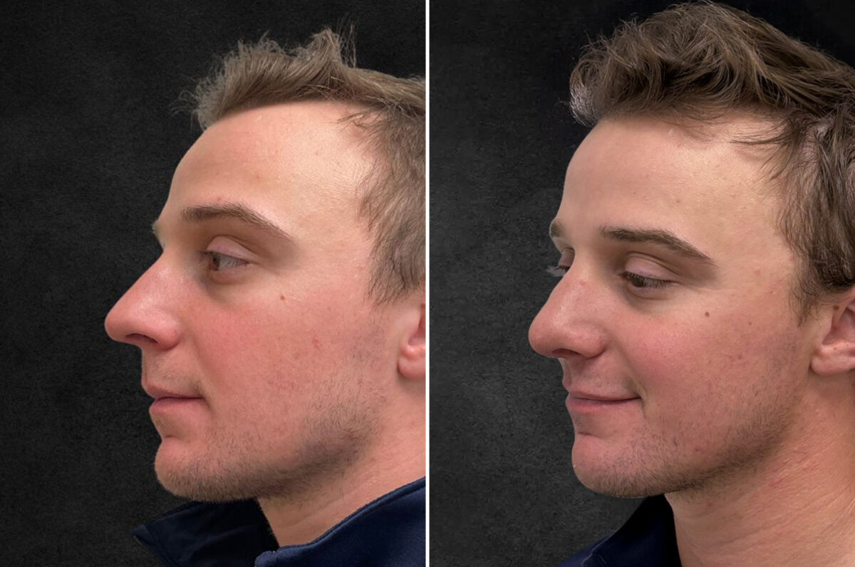 Rhinoplasty Before and After Photos in Philadelphia, PA, Patient 10850