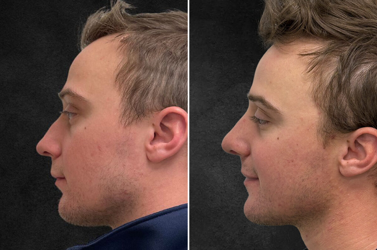 Rhinoplasty Before and After Photos in Philadelphia, PA, Patient 10850