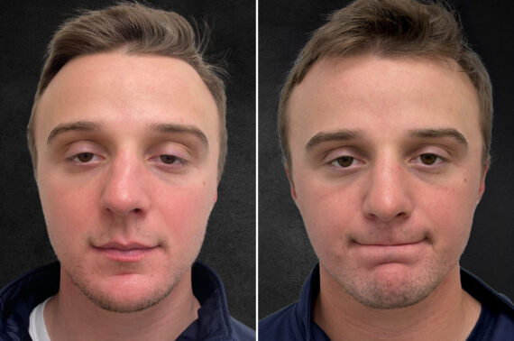 Rhinoplasty Before and After Photos in Philadelphia, PA, Patient 10850