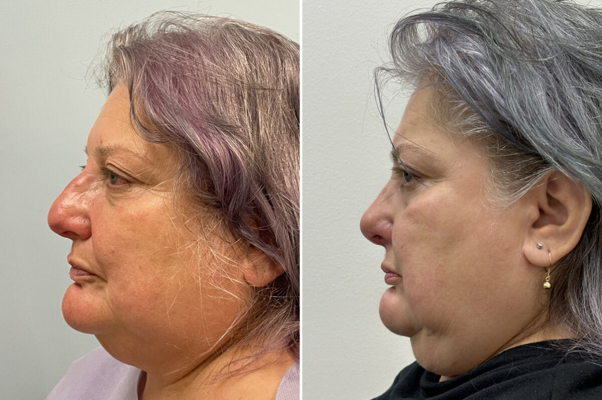 Rhinoplasty Before and After Photos in Philadelphia, PA, Patient 11853