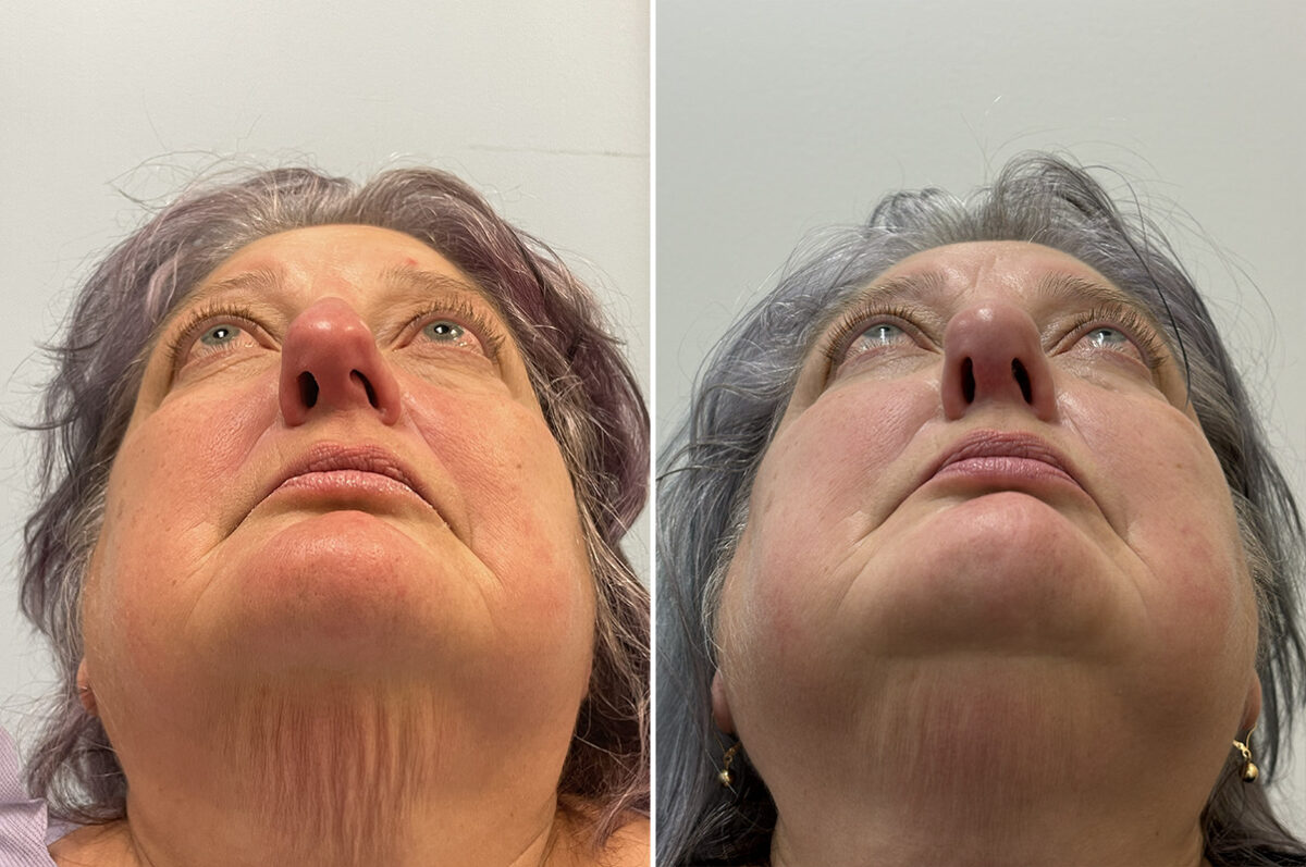 Rhinoplasty Before and After Photos in Philadelphia, PA, Patient 11853