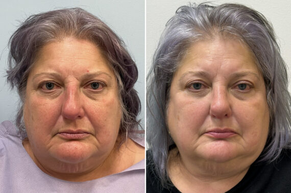 Rhinoplasty Before and After Photos in Philadelphia, PA, Patient 11853