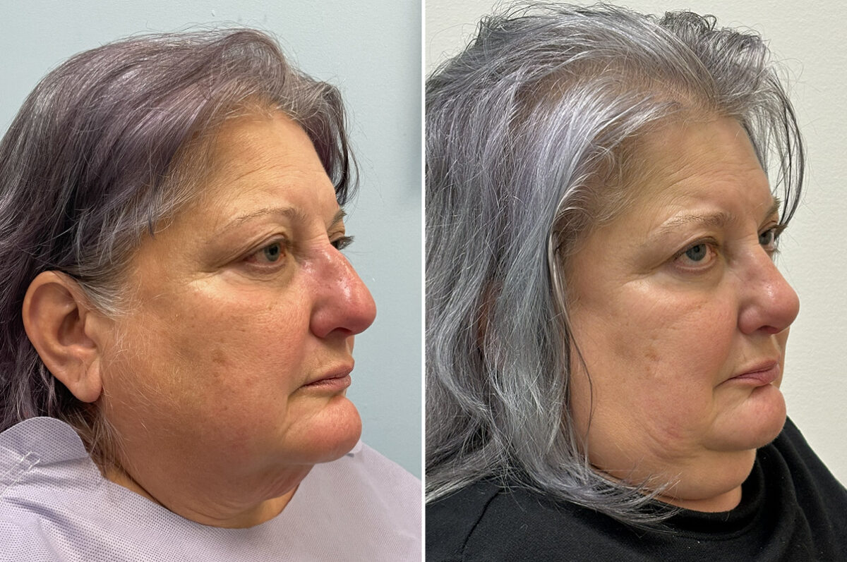 Rhinoplasty Before and After Photos in Philadelphia, PA, Patient 11853
