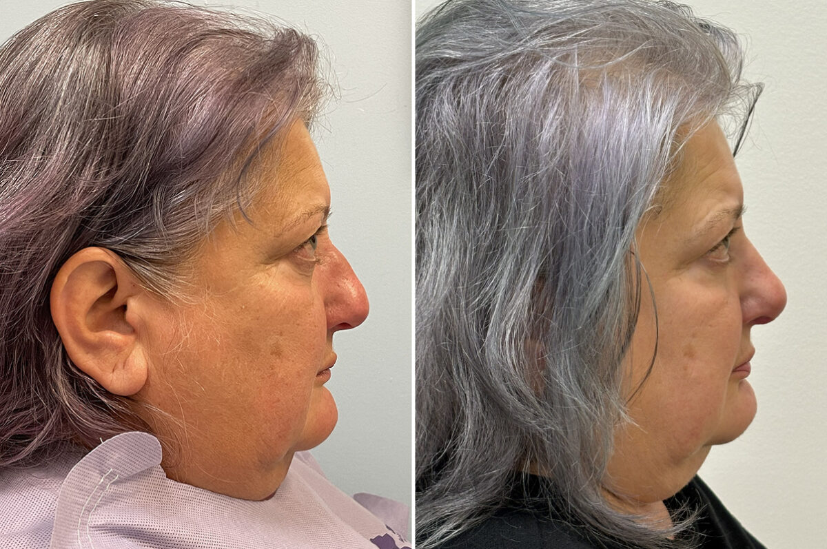 Rhinoplasty Before and After Photos in Philadelphia, PA, Patient 11853