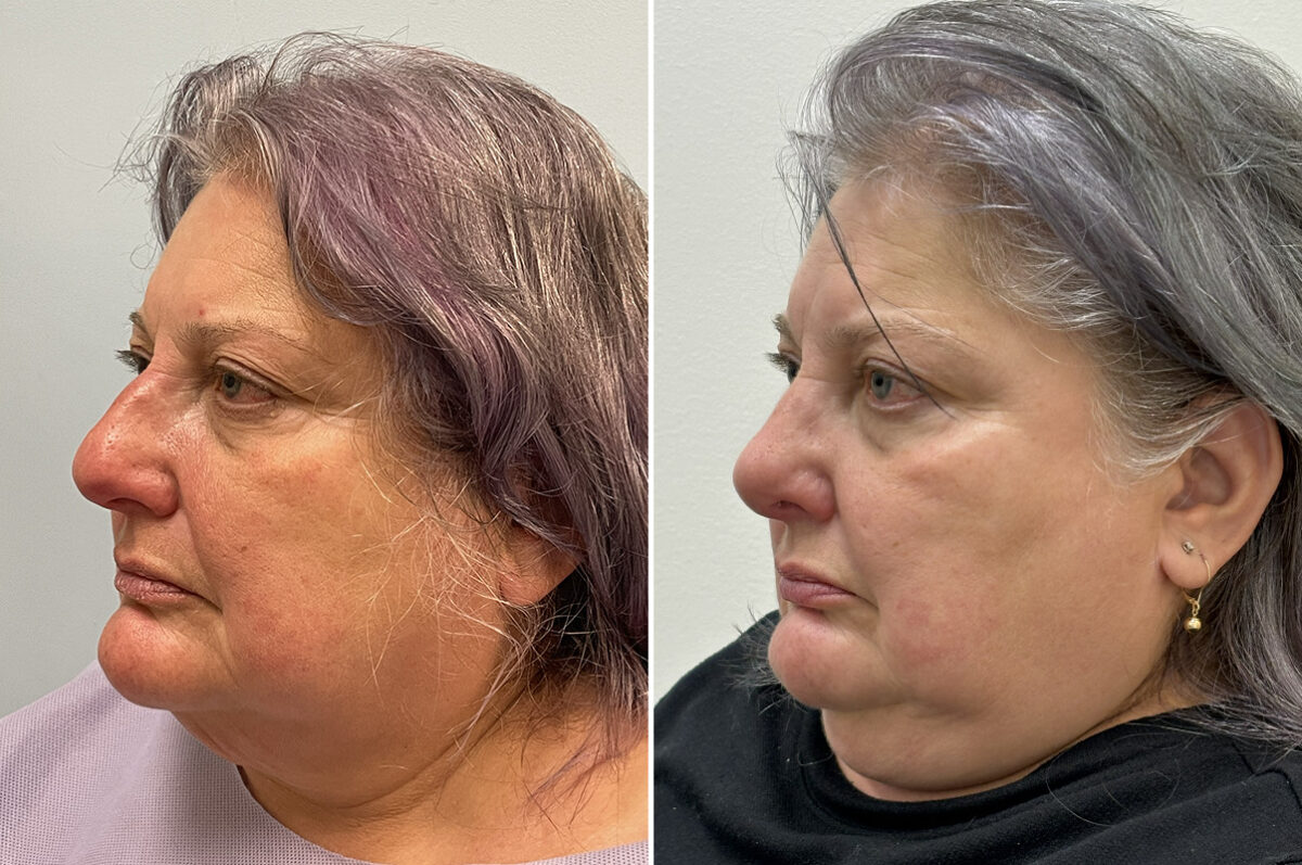 Rhinoplasty Before and After Photos in Philadelphia, PA, Patient 11853
