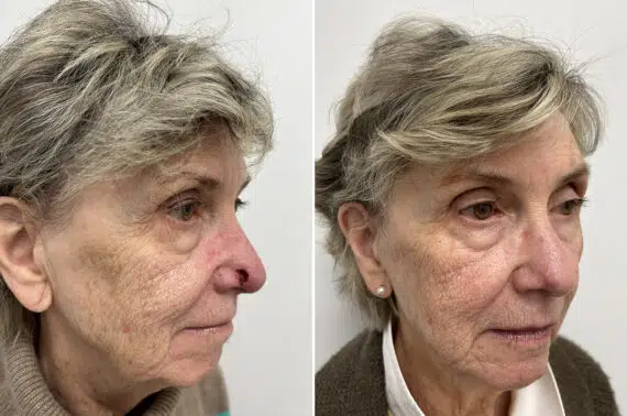 Mohs Reconstruction Before and After Photos in Princeton, NJ, Patient 12110