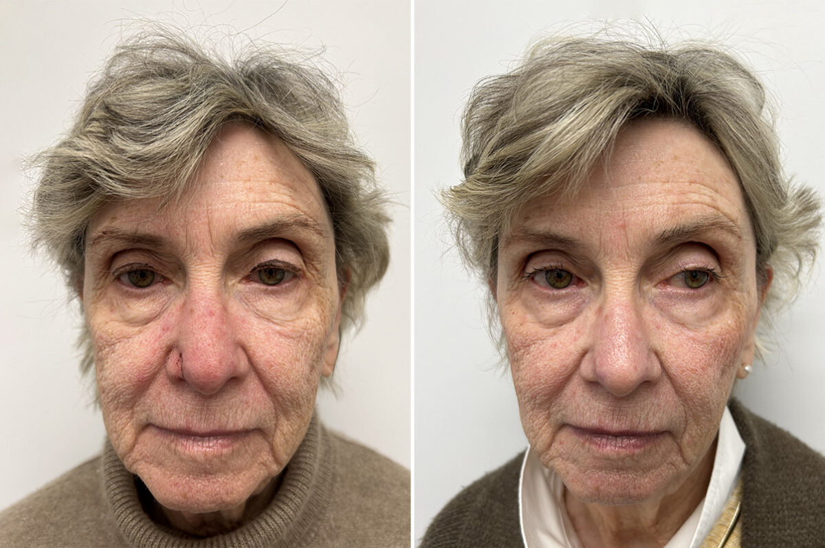 Mohs Reconstruction Before and After Photos in Princeton, NJ, Patient 12110