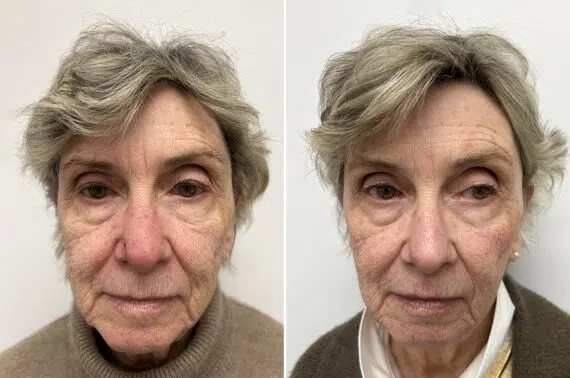 Mohs Reconstruction Before and After Photos in Princeton, NJ, Patient 12110