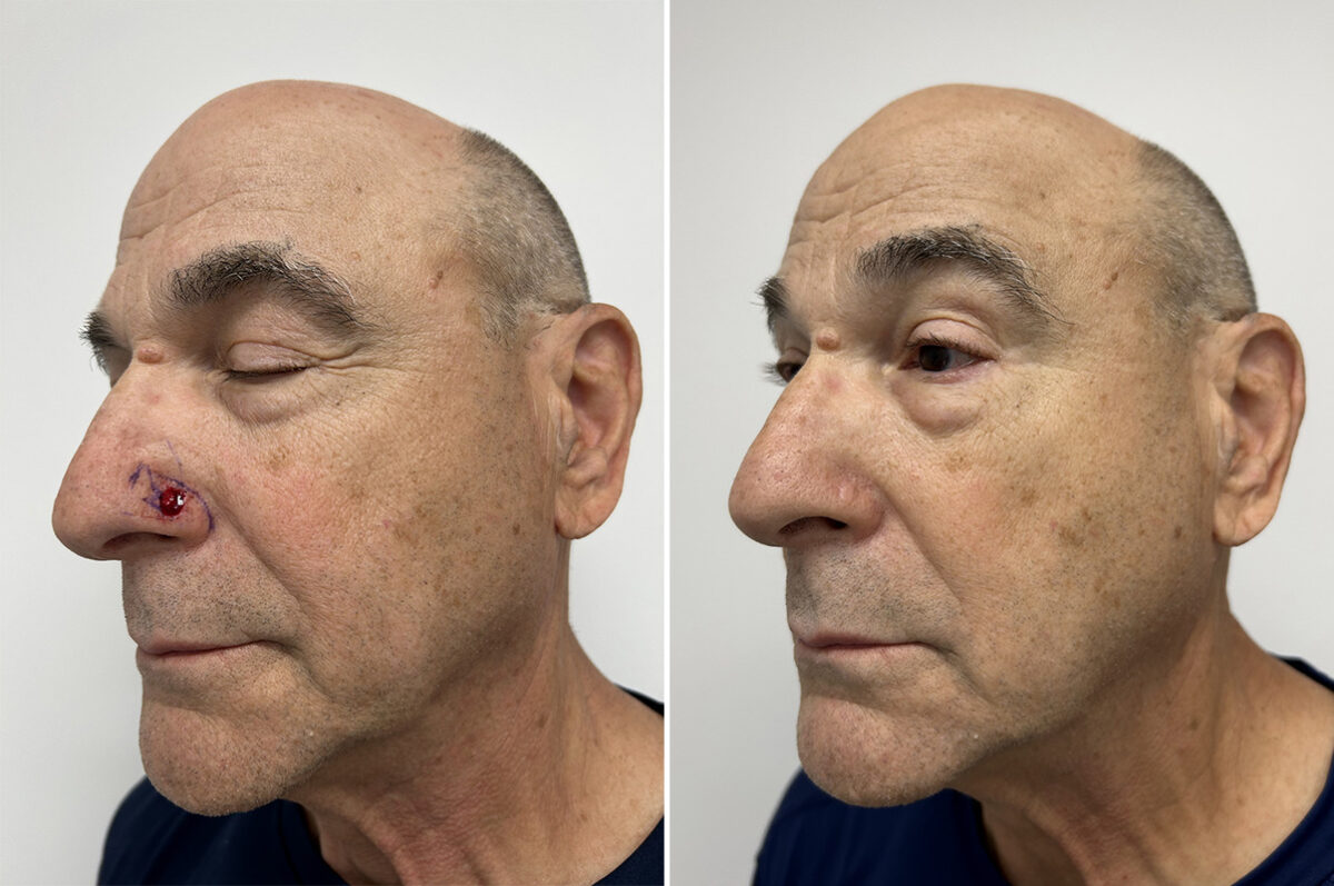 Mohs Reconstruction Before and After Photos in Princeton, NJ, Patient 12117