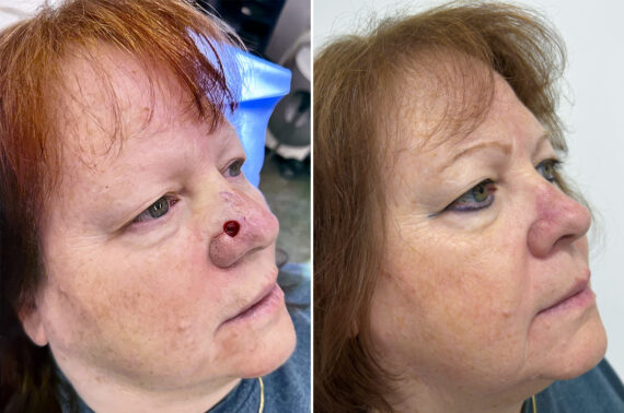 Mohs Reconstruction Before and After Photos in Princeton, NJ, Patient 12121