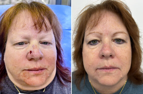 Mohs Reconstruction Before and After Photos in Princeton, NJ, Patient 12121