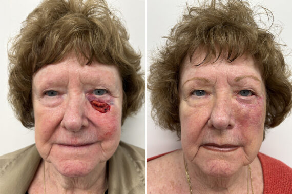 Mohs Reconstruction Before and After Photos in Princeton, NJ, Patient 12128