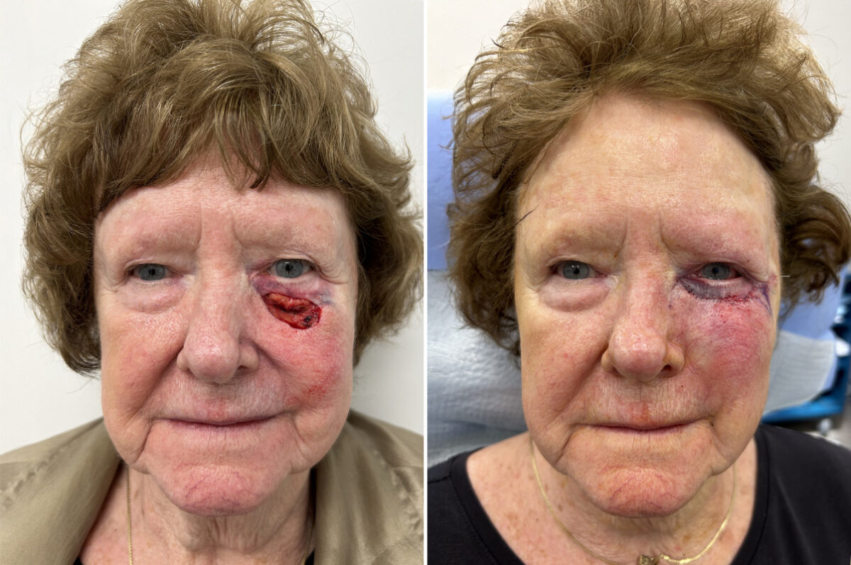 Mohs Reconstruction Before and After Photos in Princeton, NJ, Patient 12128