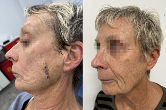 Mohs Reconstruction Before and After Photos in Princeton, NJ, Patient 12134