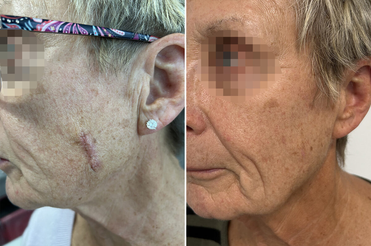 Mohs Reconstruction Before and After Photos in Princeton, NJ, Patient 12134