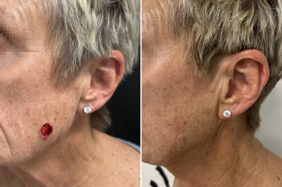 Mohs Reconstruction Before and After Photos in Princeton, NJ, Patient 12134