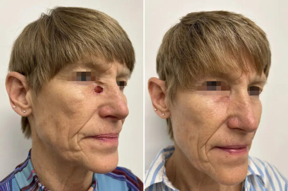 Mohs Reconstruction Before and After Photos in Princeton, NJ, Patient 12144